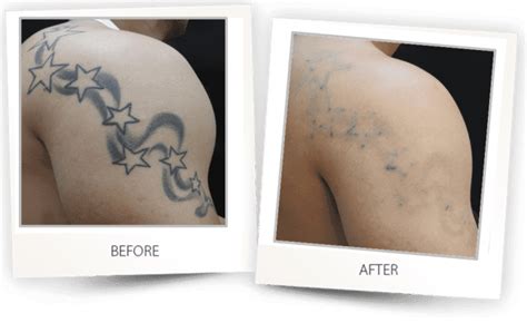 Say Goodbye to Unwanted Ink: Tattoo Removal in Tulsa